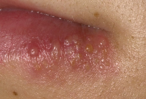 Herpes Type 1